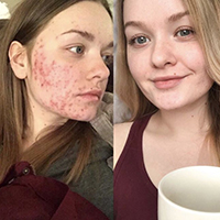 Cystic Acne: How to Identify and Treat the Skin Condition